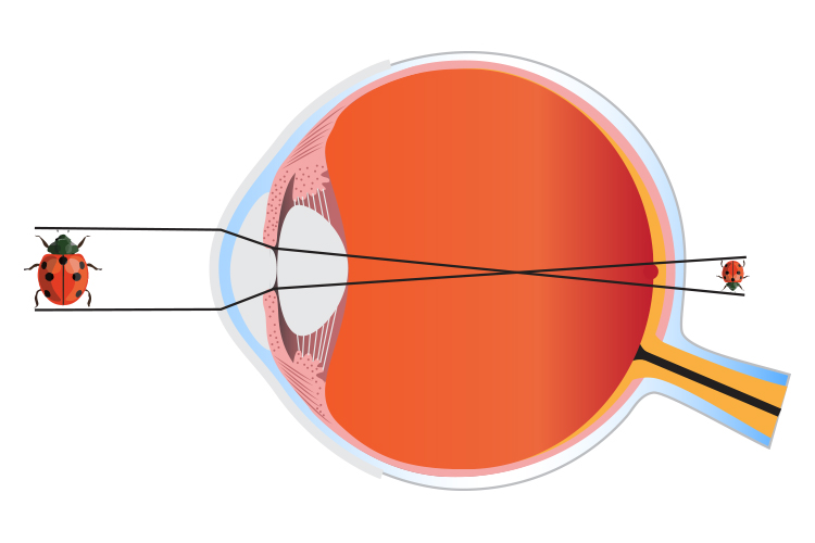 Ray diagram of a hypermetropic eye forming an image behind the retina